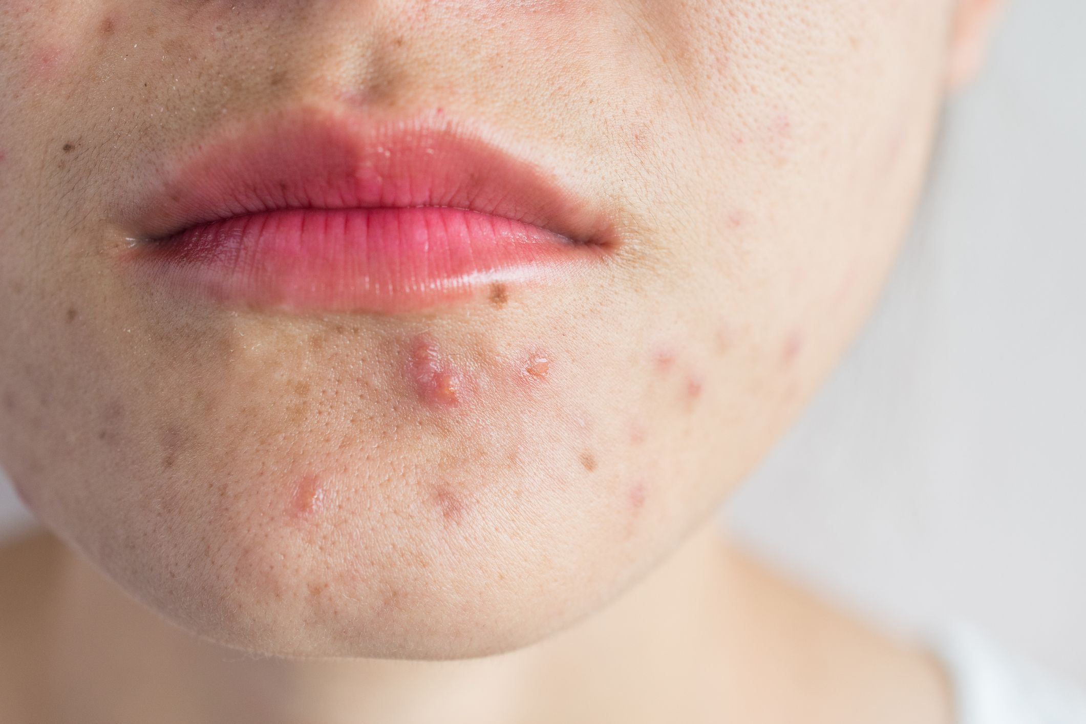 Consejos para prevenir el acné causado por la mascarilla